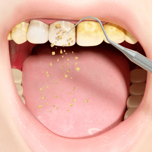 how to prevent dental tartar
